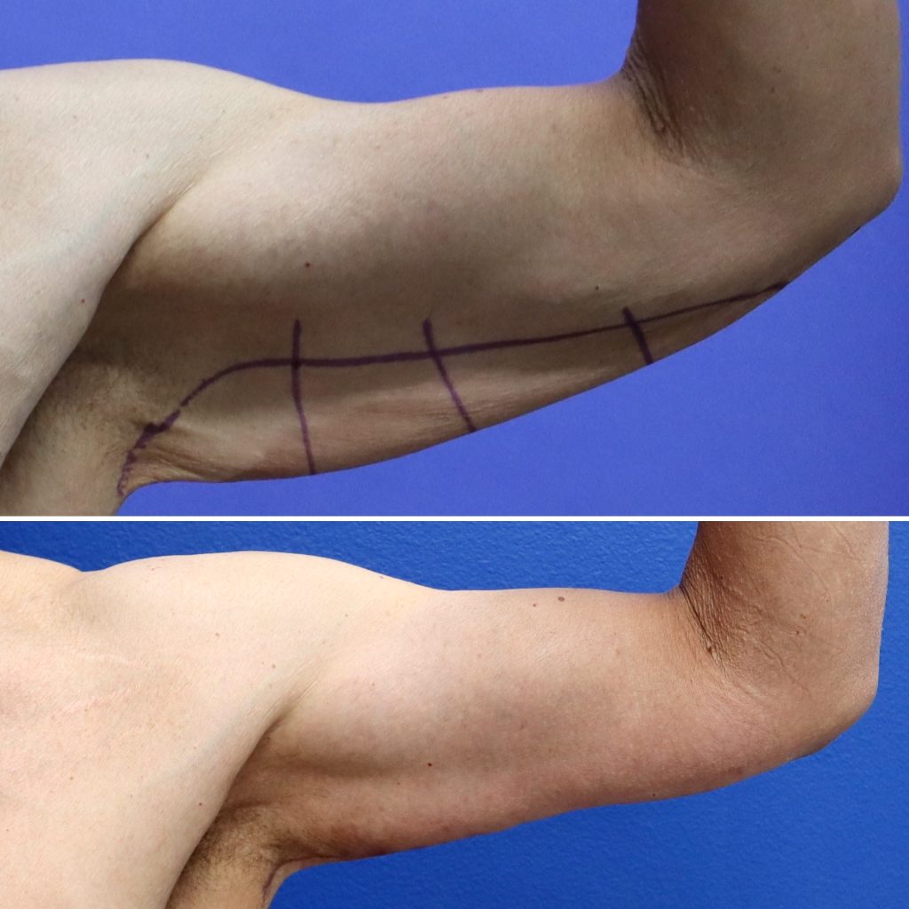 Before and After - Brachioplasty (Arm Lift)