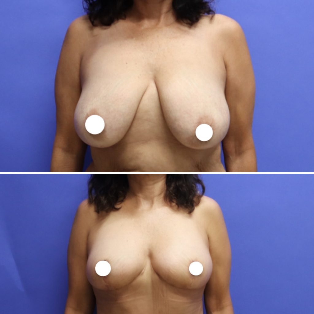 Before and After - Levantamiento de senos