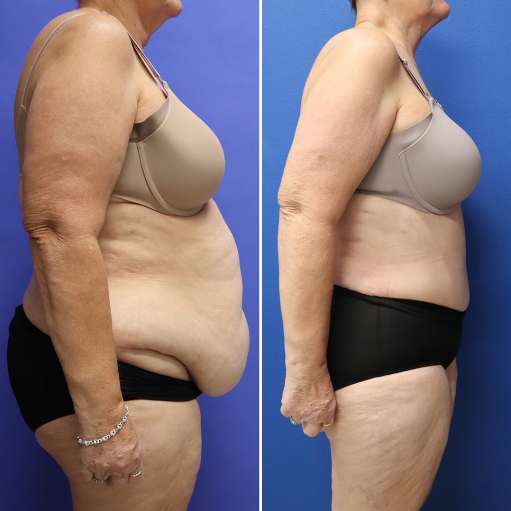 Before and After - Abdominoplasty