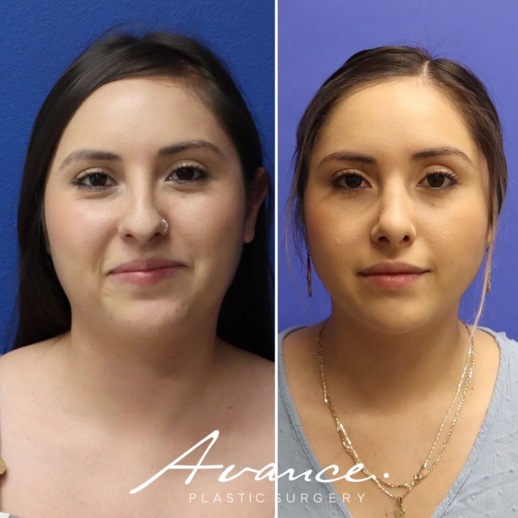Before and After - Rinoplastia