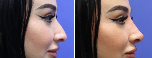 Before and After - Non-Surgical Rhinoplasty