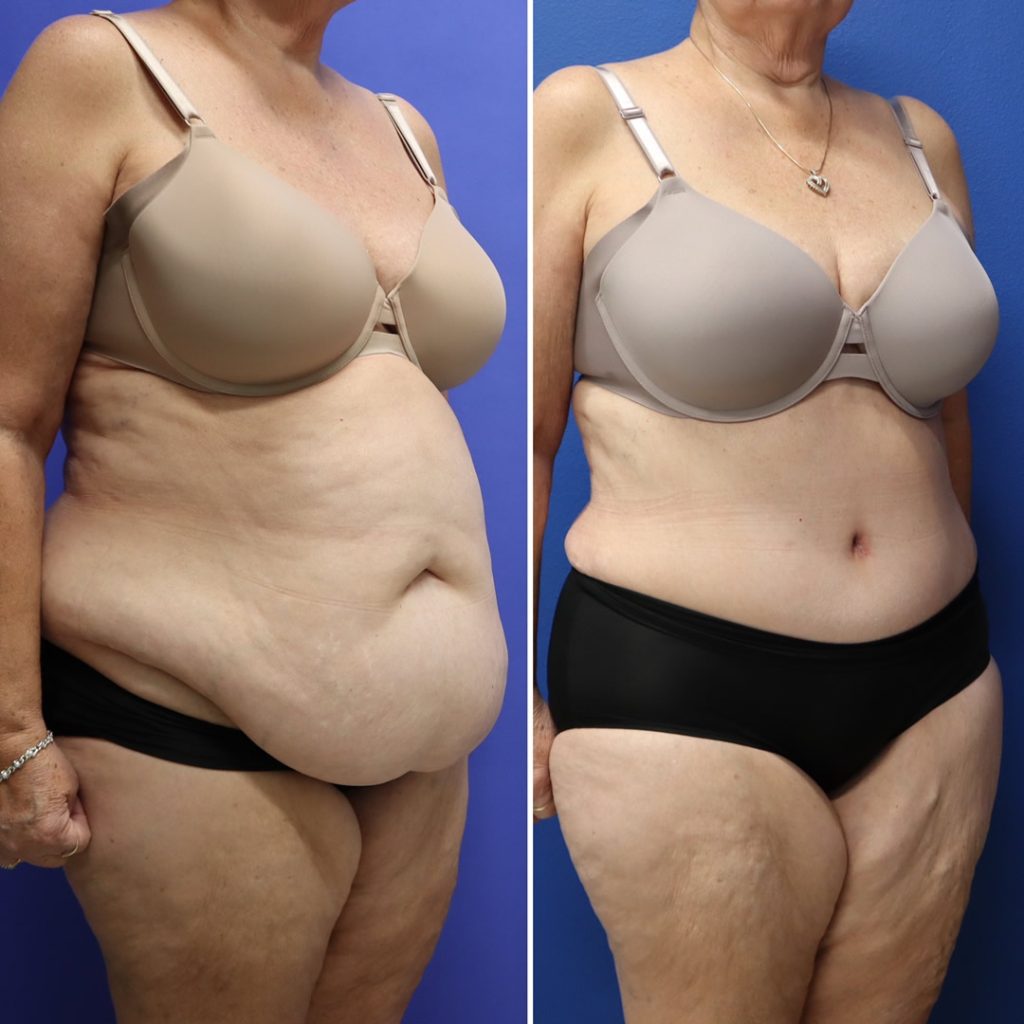 Before and After - Abdominoplasty