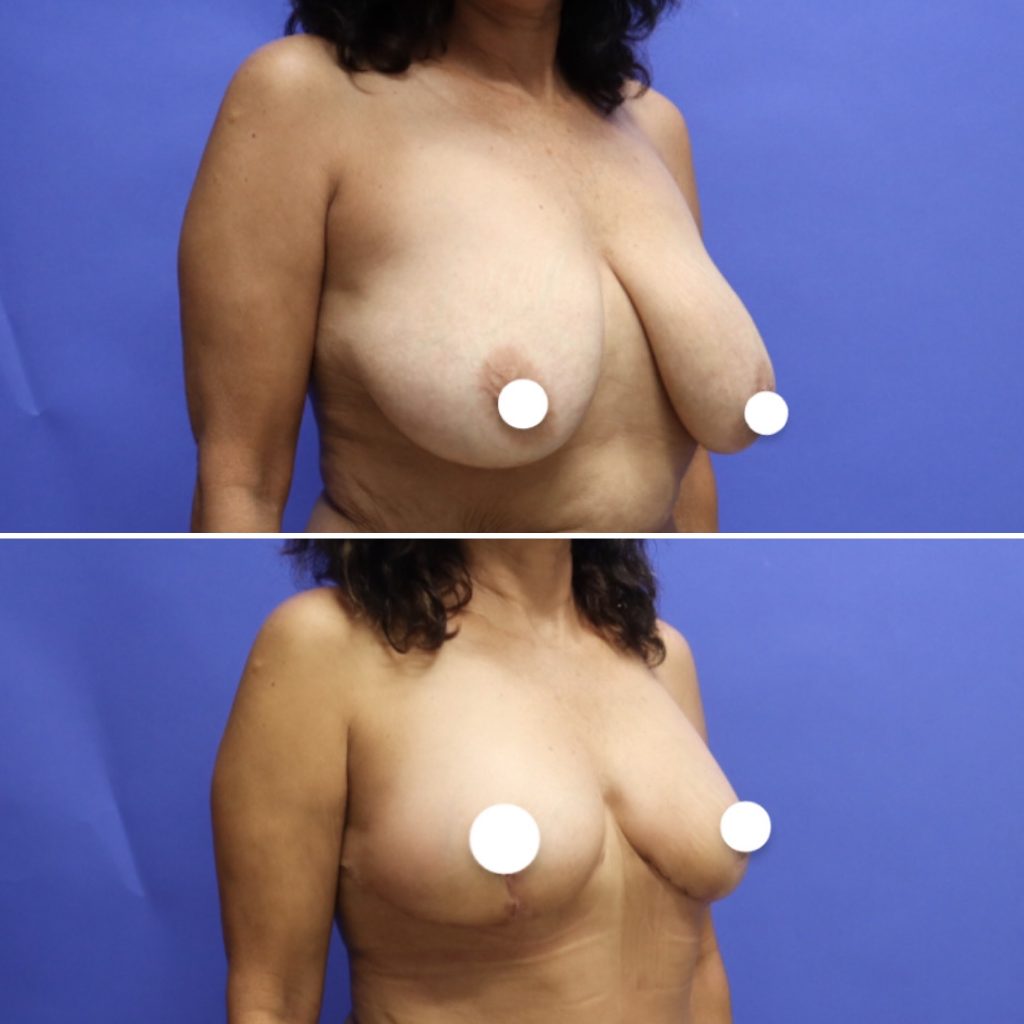 Before and After - Levantamiento de senos