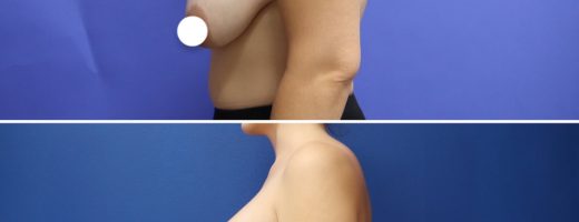 Before and After - Breast lift with implants (Augmentation Mastopexy)