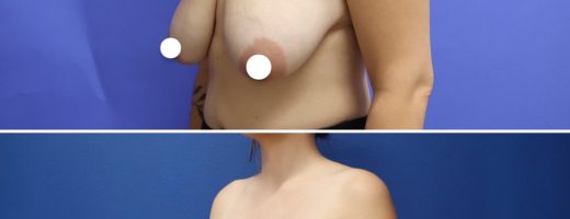 Before and After - Elevación de pecho con implantes (Mastopexia de aumento)
