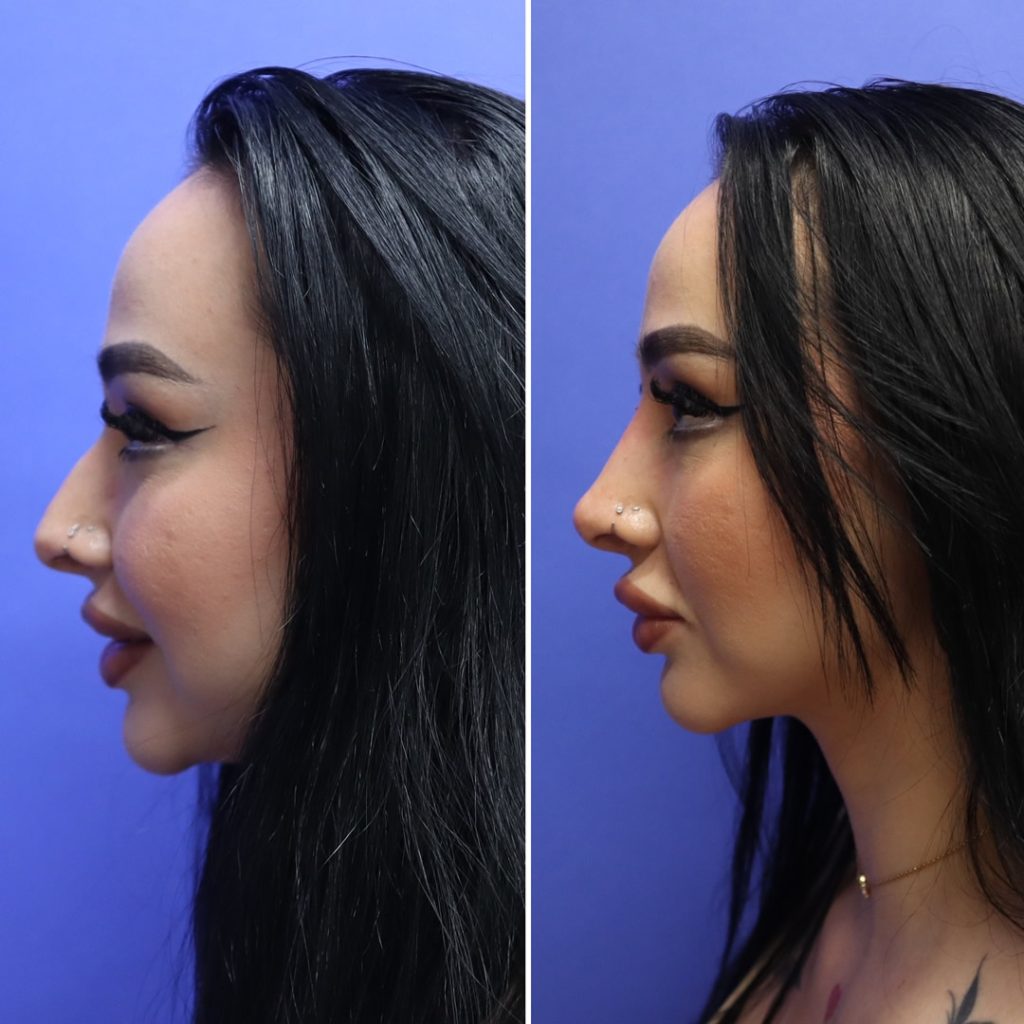 Before and After - Non-Surgical Rhinoplasty