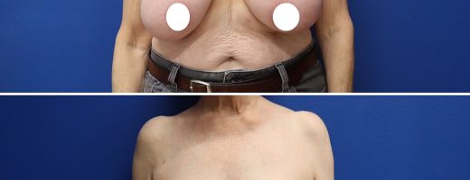 Before and After - Breast Reduction