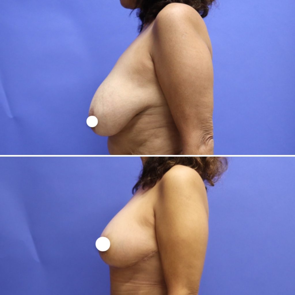 Before and After - Breast Lift