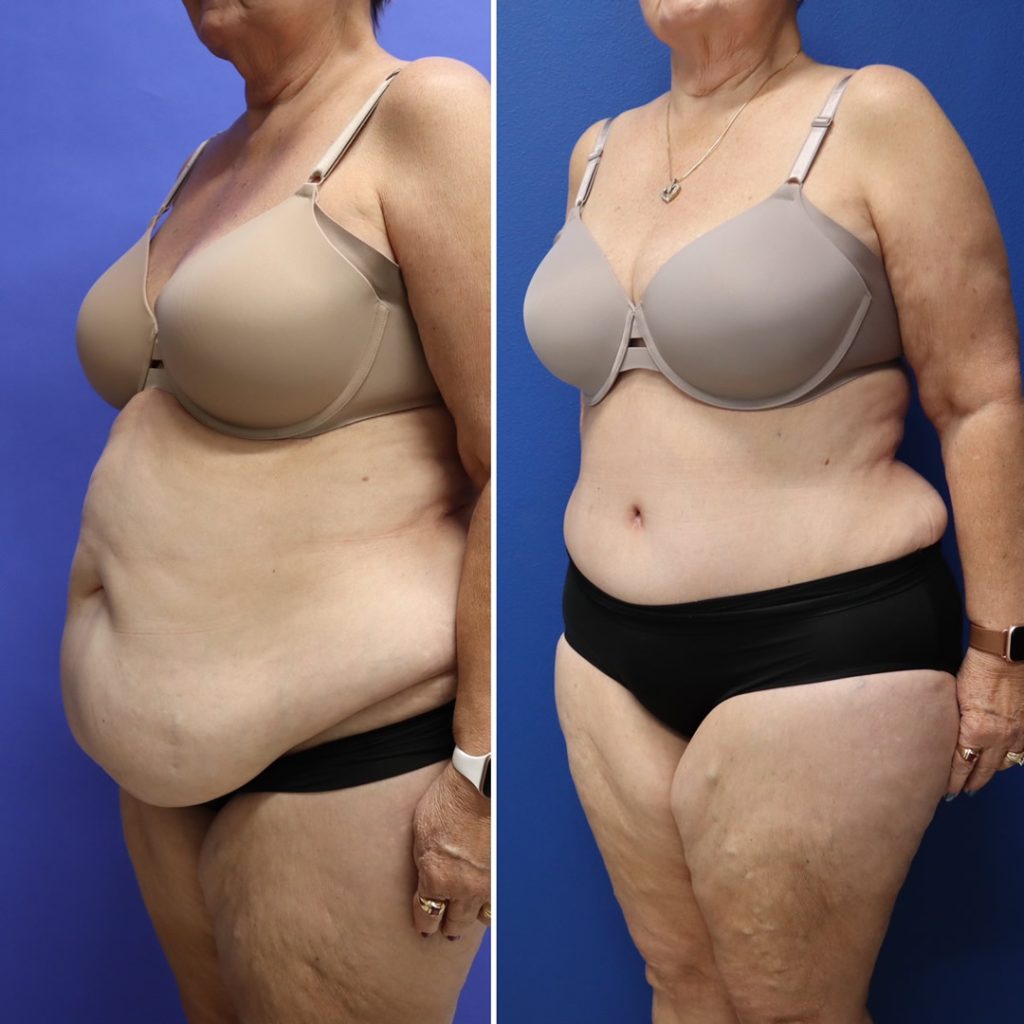 Before and After - Abdominoplastia