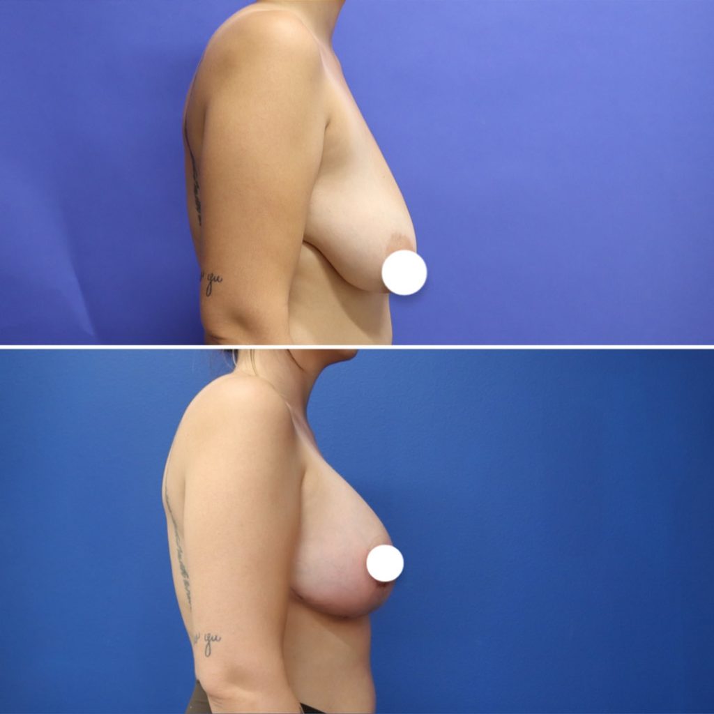 Before and After - Breast lift with implants (Augmentation Mastopexy)