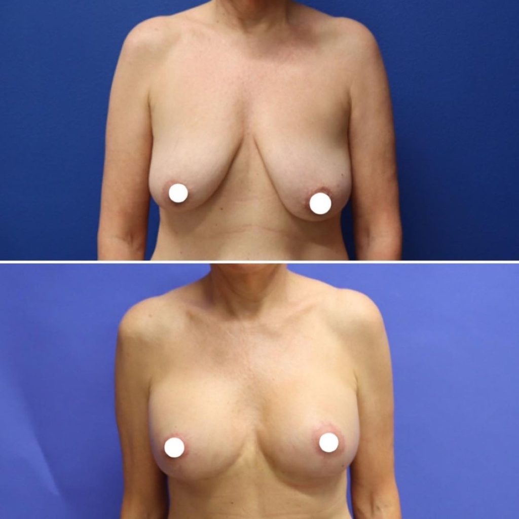 Before and After - Elevación de pecho con implantes (Mastopexia de aumento)