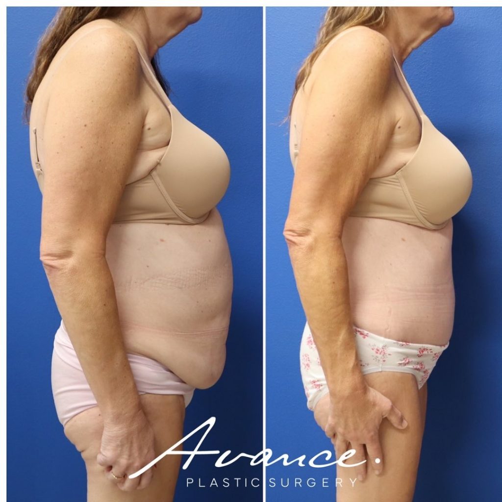 Before and After - Abdominoplastia