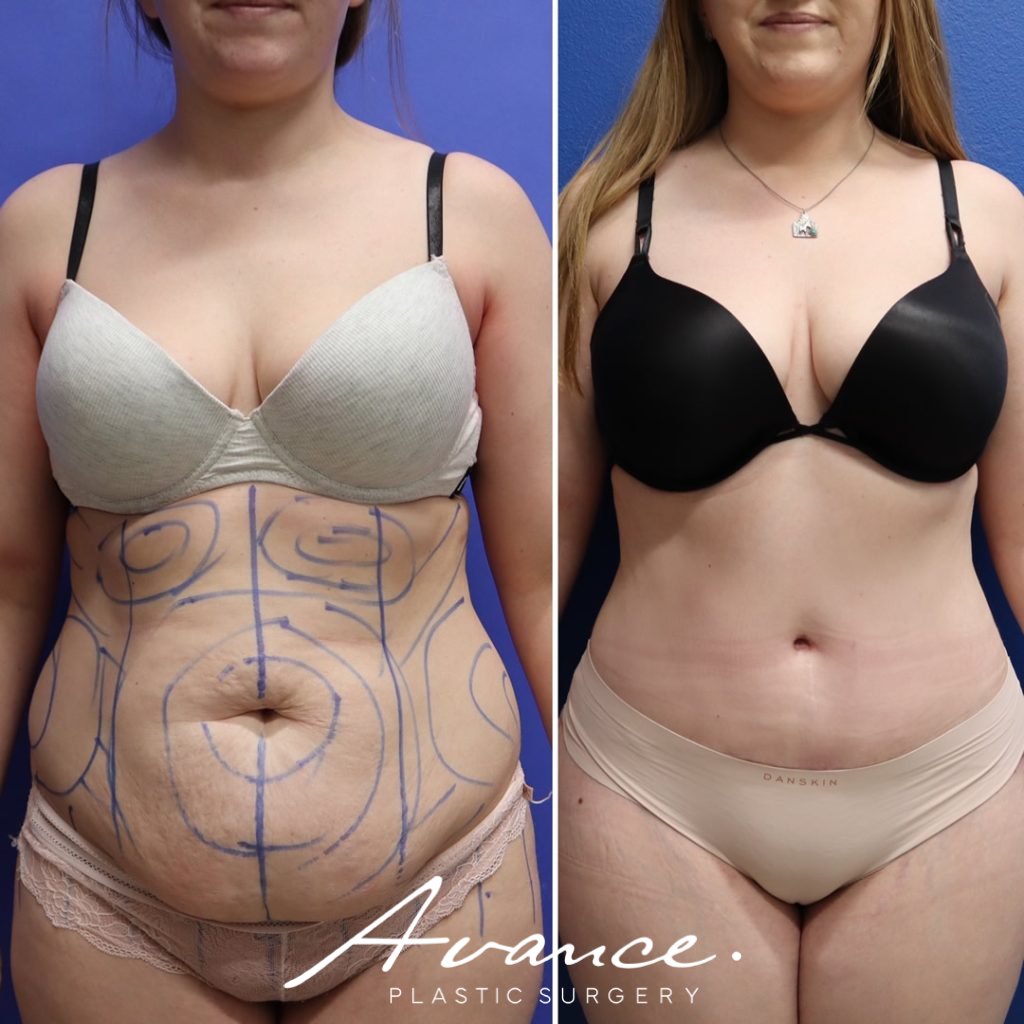 Before and After - Abdominoplasty