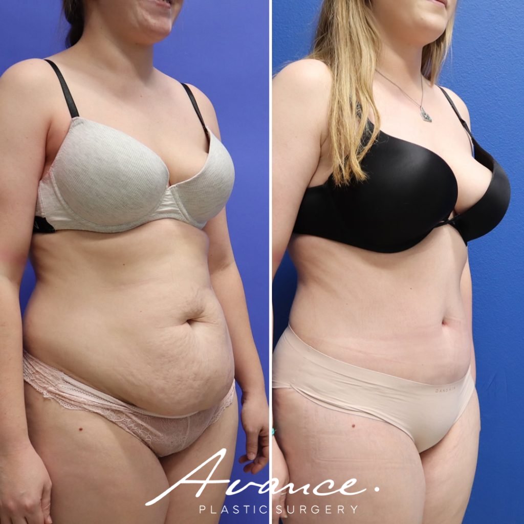 Before and After - Abdominoplasty