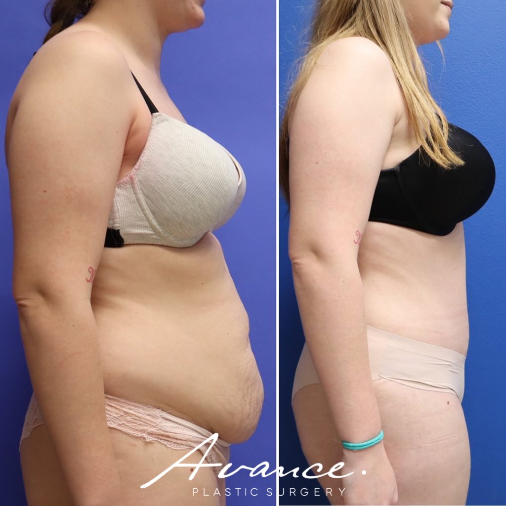 Before and After - Abdominoplasty