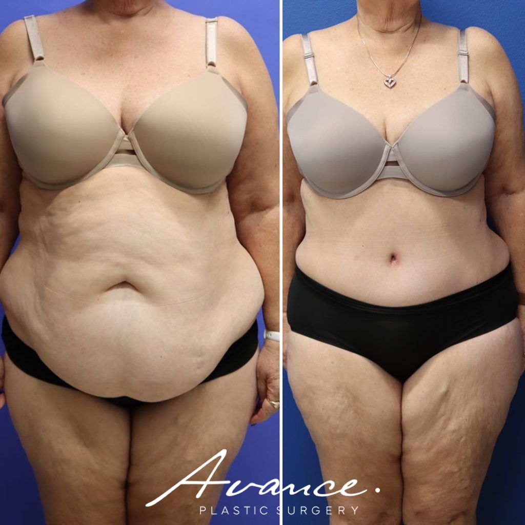 Before and After - Abdominoplasty