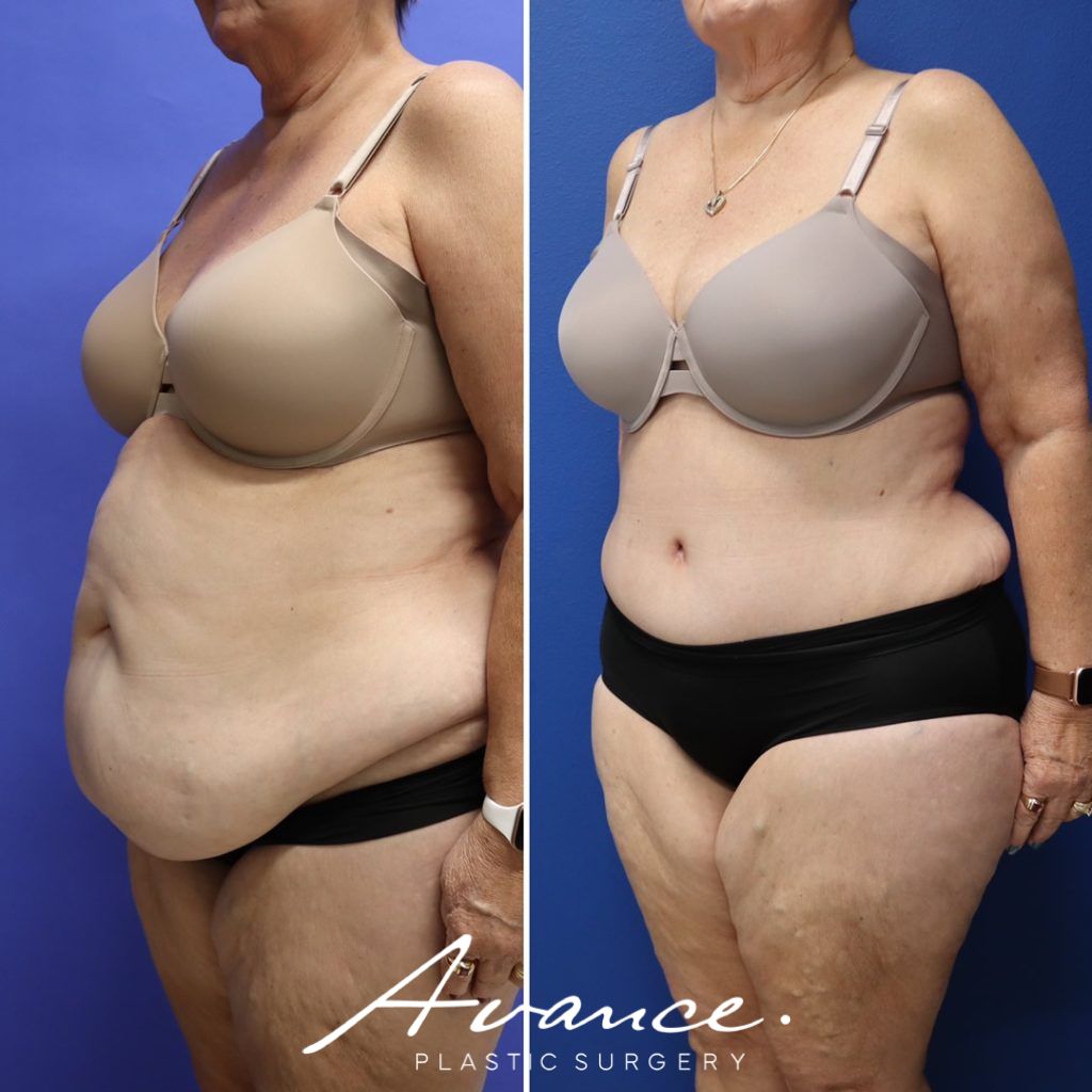 Before and After - Abdominoplasty