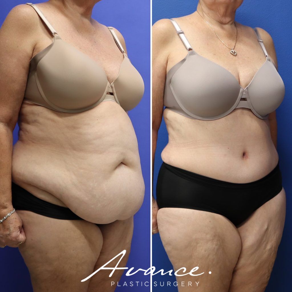 Before and After - Abdominoplasty