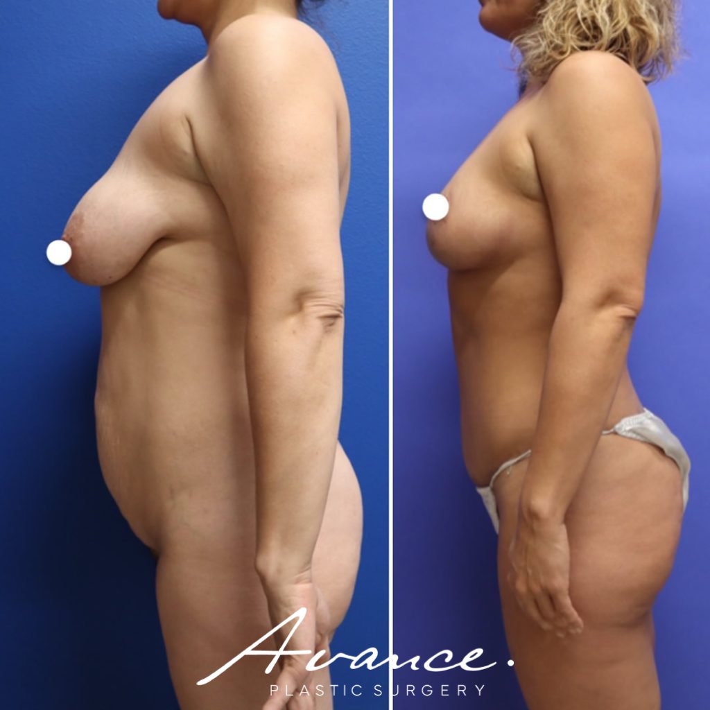 Before and After - Breast Lift