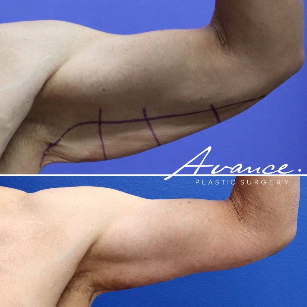 Before and After - Brachioplasty (Arm Lift)