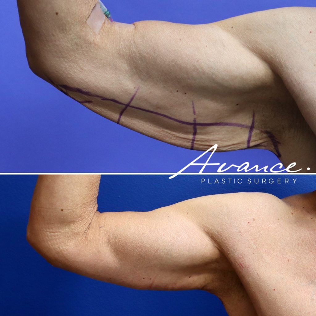 Before and After - Brachioplasty (Arm Lift)