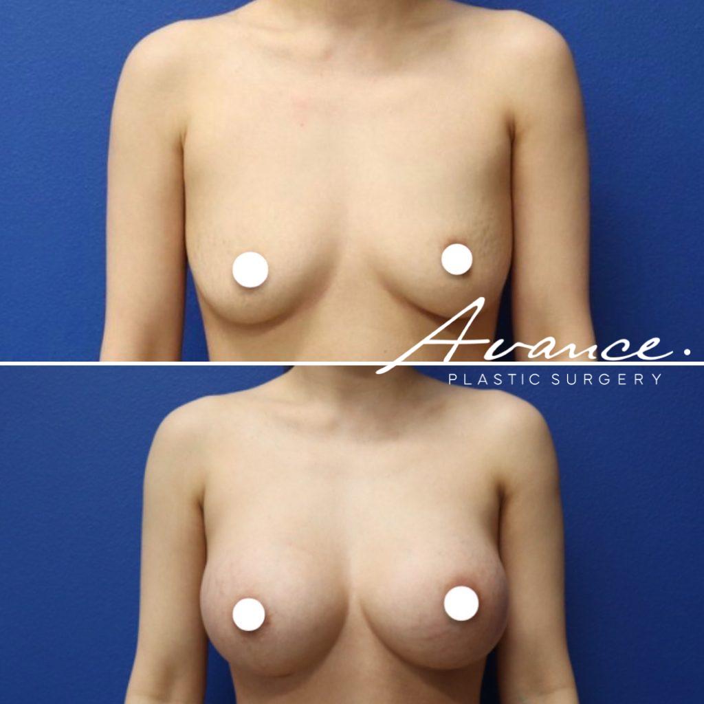 Before and After - Aumento de pecho