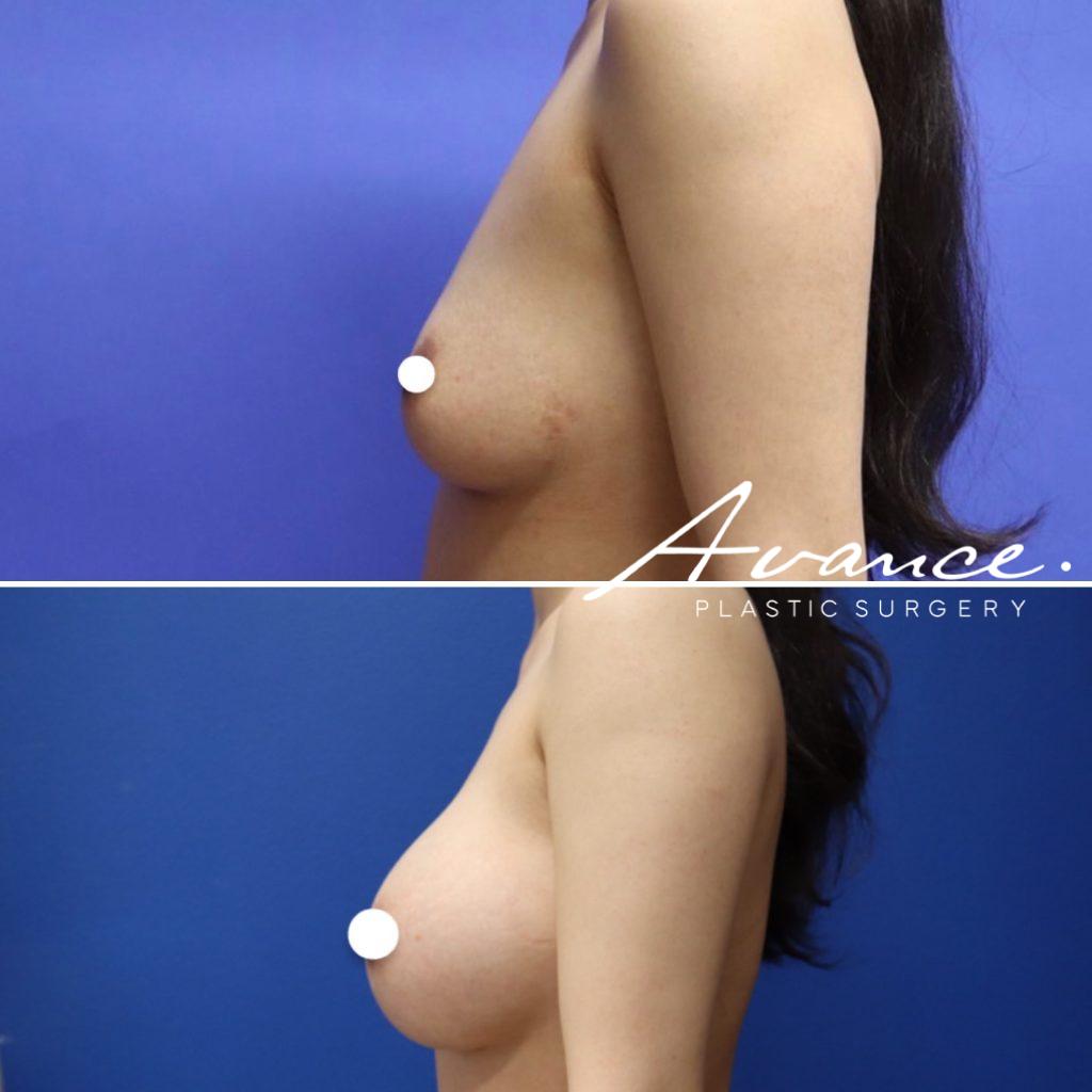 Before and After - Aumento de pecho