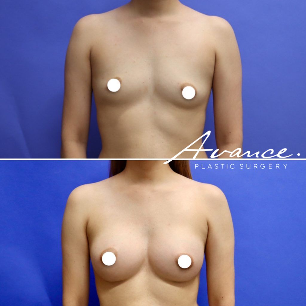 Before and After - Aumento de pecho