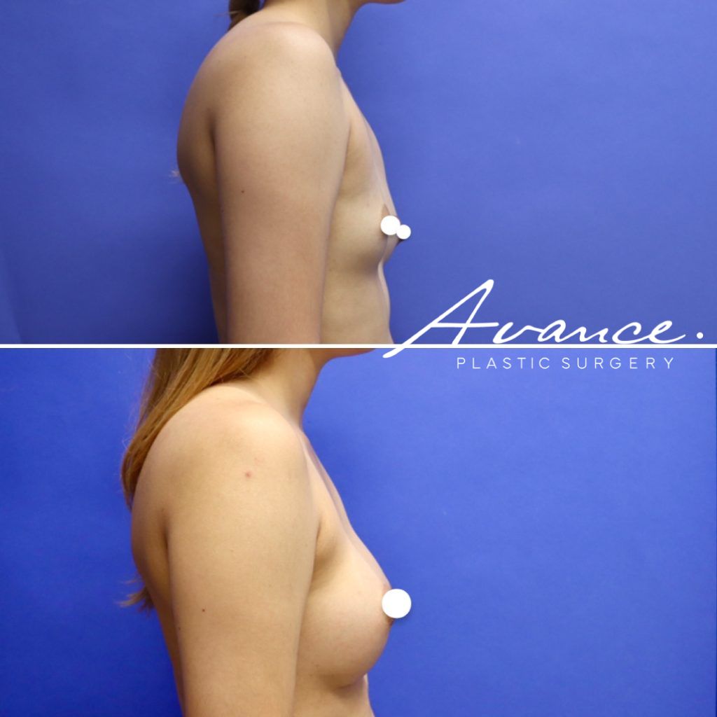 Before and After - Aumento de pecho