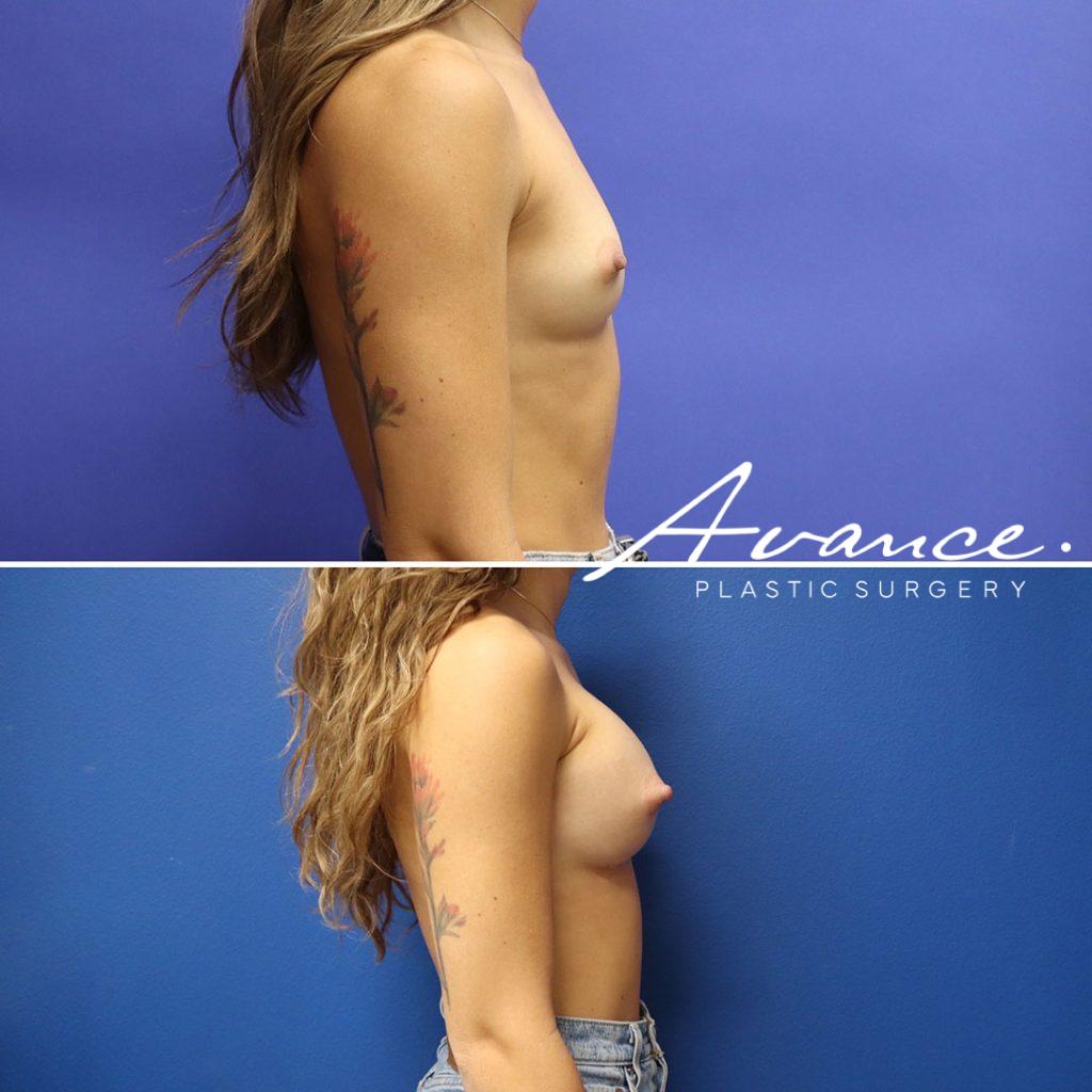 Before and After - Aumento de pecho