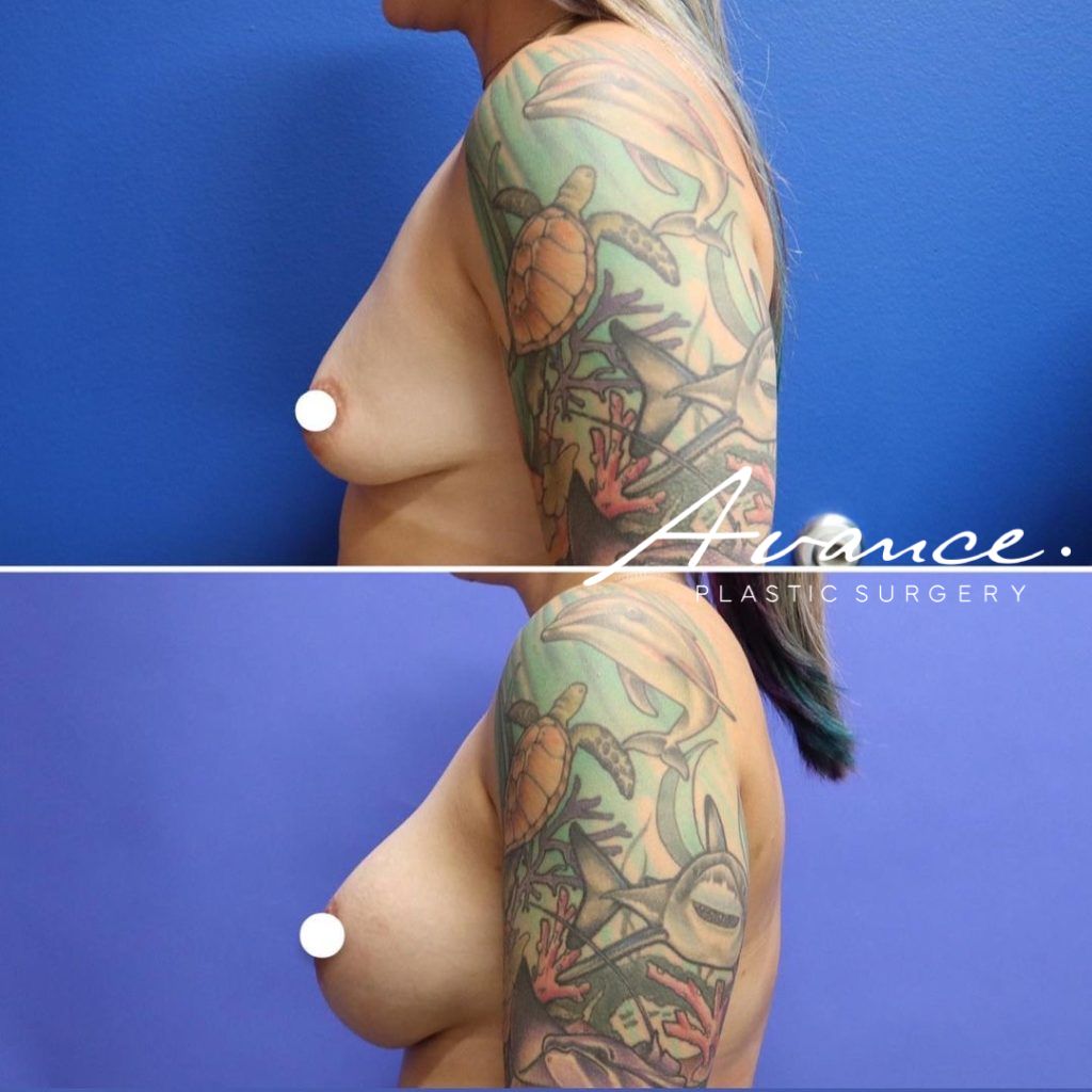Before and After - Aumento de pecho