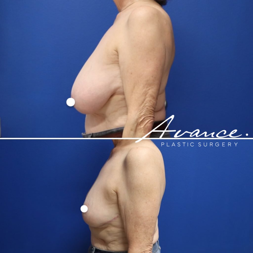 Before and After - Breast Reduction