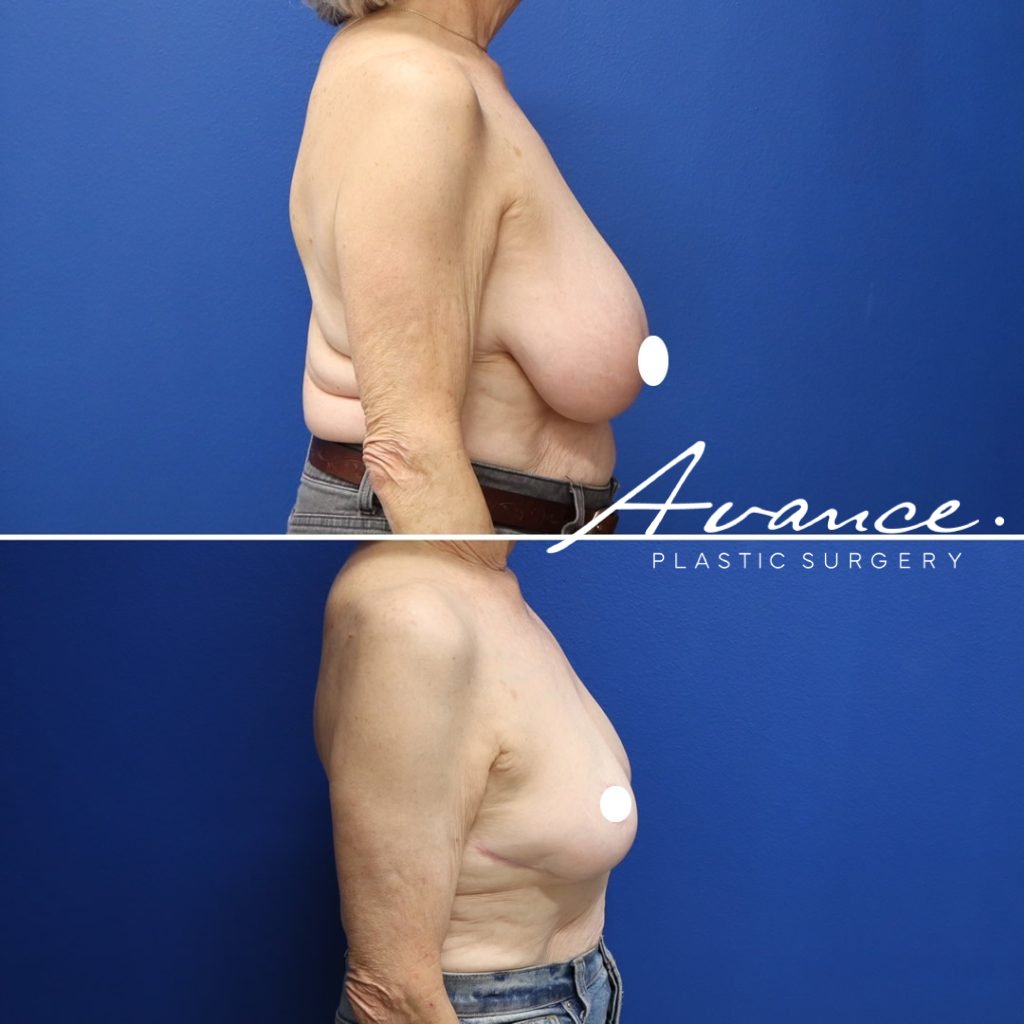 Before and After - Breast Reduction