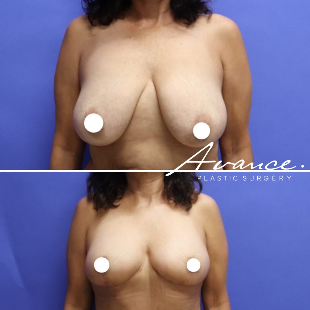 Before and After - Breast Lift