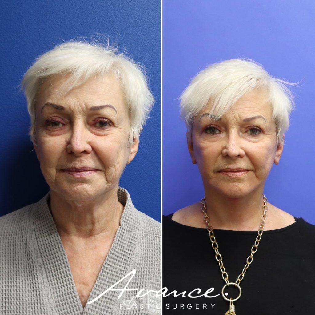 Before and After - Facelift/Necklift & Minifacelift/Necklift