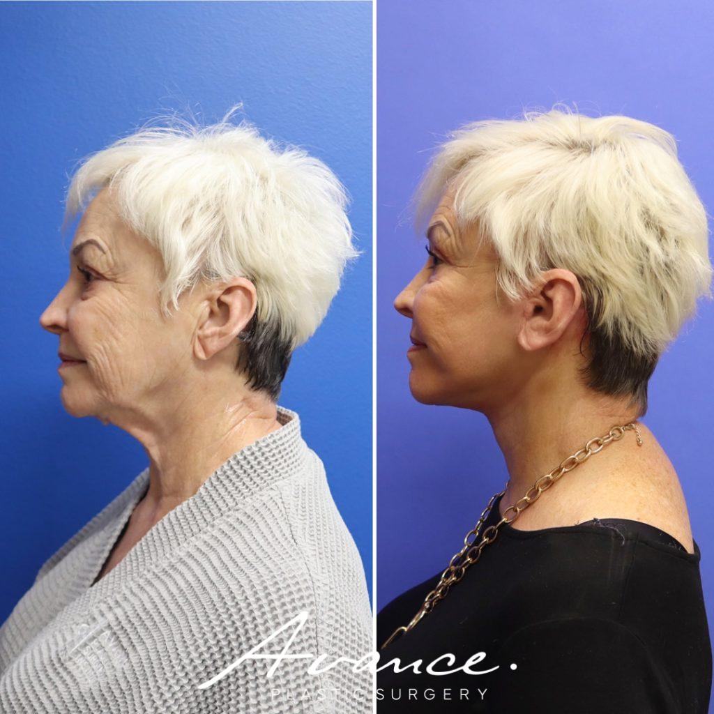Before and After - Facelift/Necklift & Minifacelift/Necklift