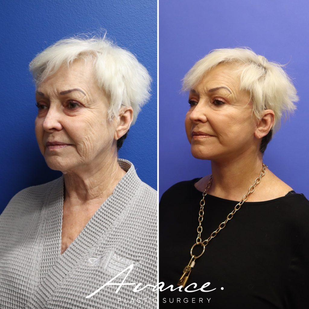 Before and After - Facelift/Necklift & Minifacelift/Necklift