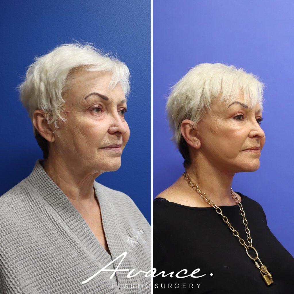 Before and After - Facelift/Necklift & Minifacelift/Necklift