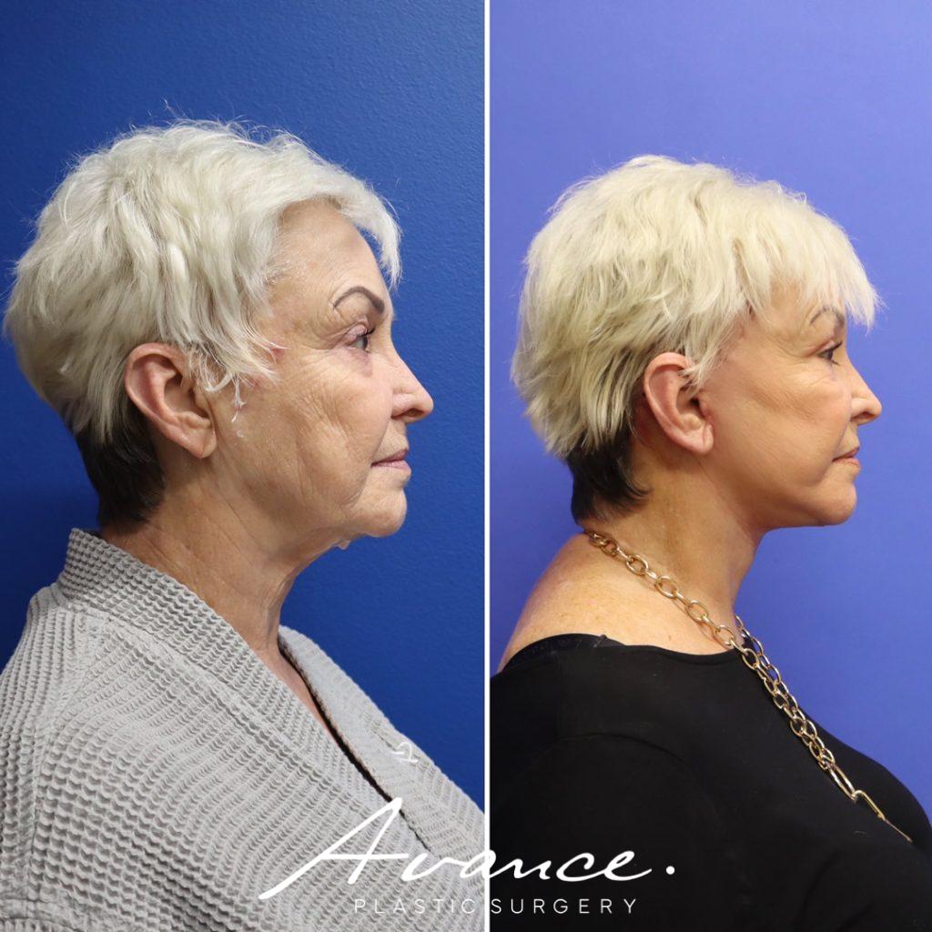 Before and After - Facelift/Necklift & Minifacelift/Necklift