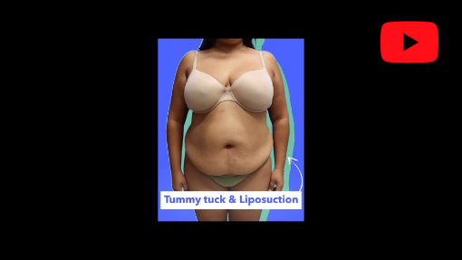 YouTube video titled Tummy Tuck & Liposuction Before And After | Avance Plastic Surgery Institute: Dr. Erez Dayan | Reno