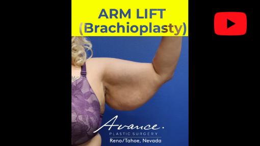 YouTube video titled Reno/Tahoe Brachioplasty/Arm Lift Before & After | Dr. Erez Dayan | Avance Plastic Surgery