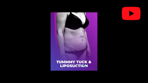 YouTube video titled Before And After Liposuction & Tummy Tuck | Avance Plastic Surgery Institute: Dr. Erez Dayan | Tahoe