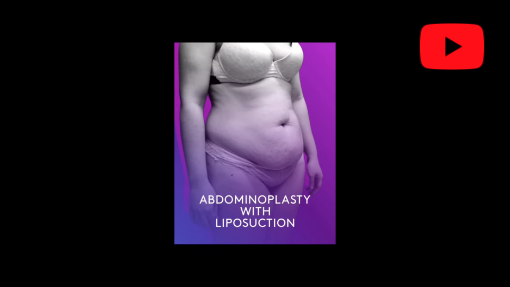 YouTube video titled Abdominoplasty And Liposuction | Avance Plastic Surgery | Dr. Erez Dayan | Reno, Tahoe, NV