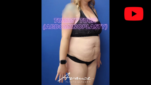 YouTube video titled Reno Tummy Tuck/Abdominoplasty Before and After | Avance Plastic Surgery: Dr. Erez Dayan | Tahoe, NV