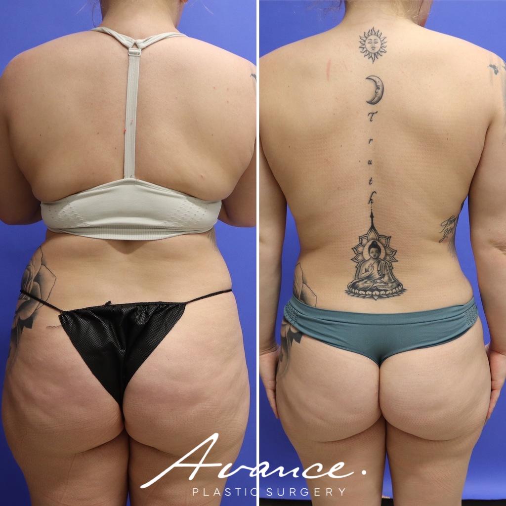 Before and After - 360 Liposucción