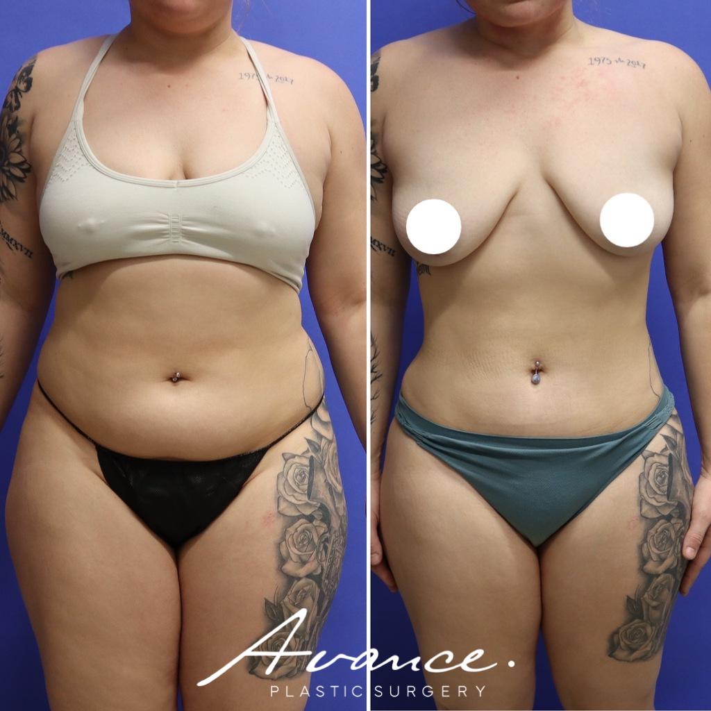 Before and After - 360 Liposucción