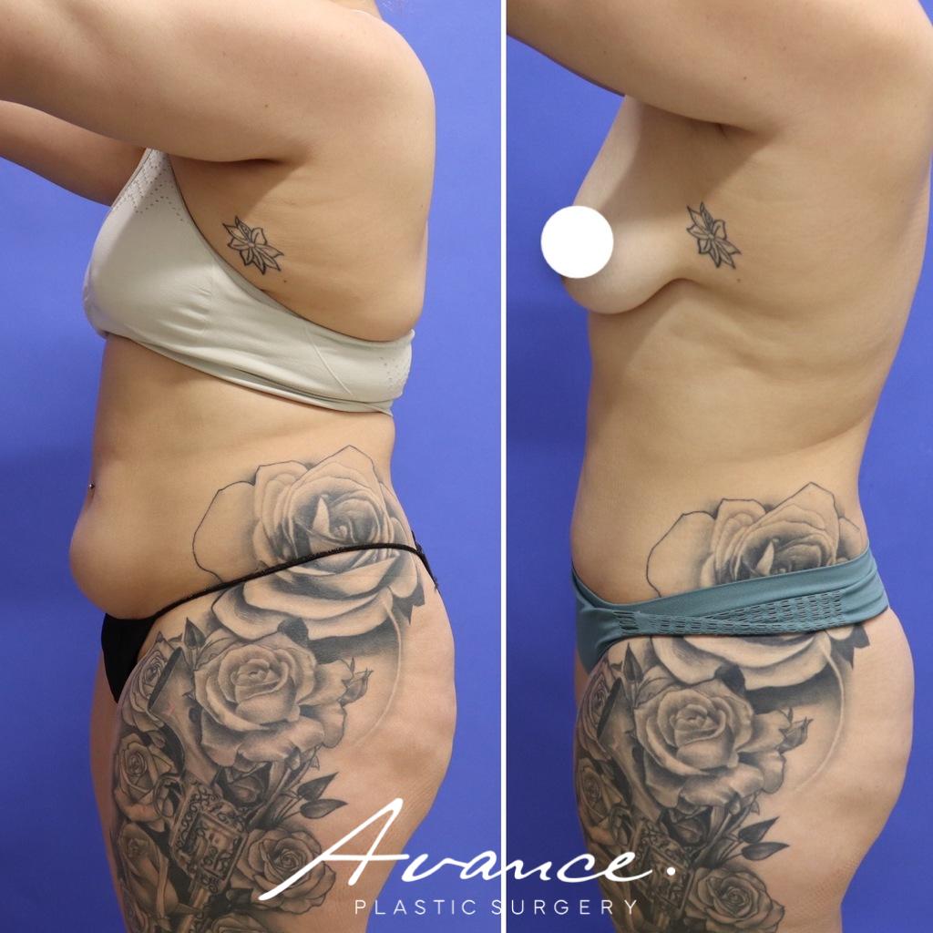 Before and After - 360 Liposucción