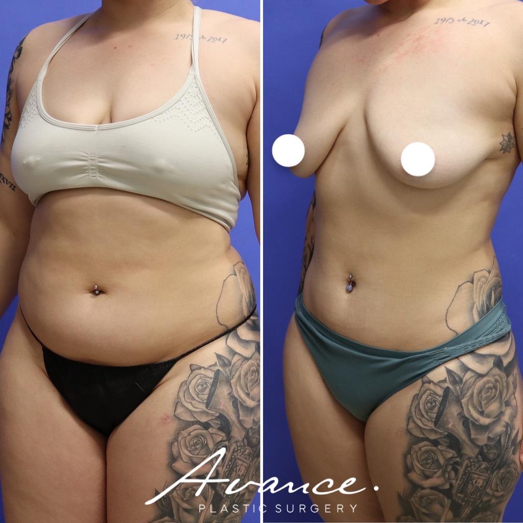 Before and After - 360 Liposucción