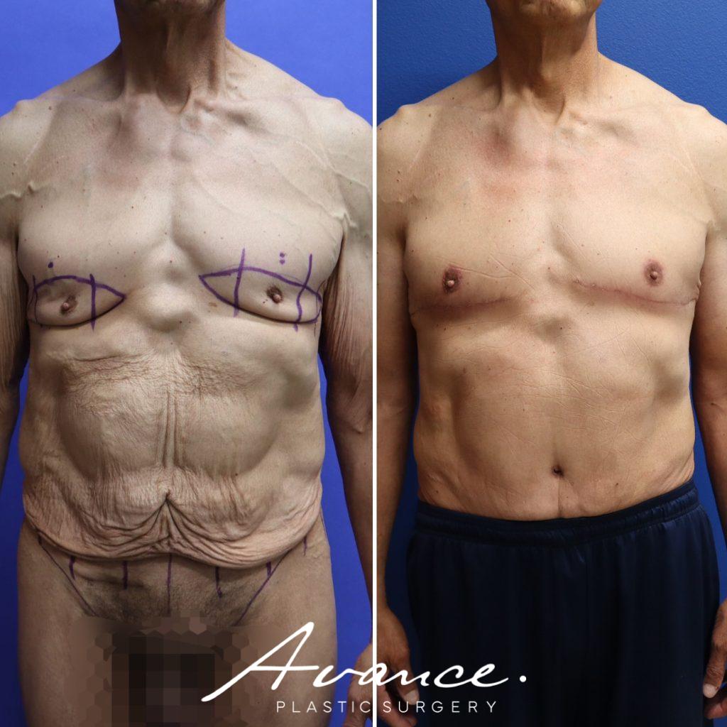 Before and After - Body Contouring After Weight Loss
