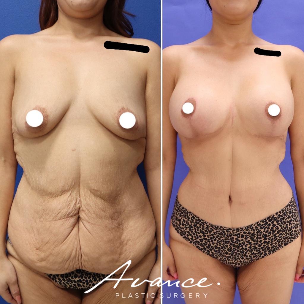 Before and After - Body Contouring After Weight Loss